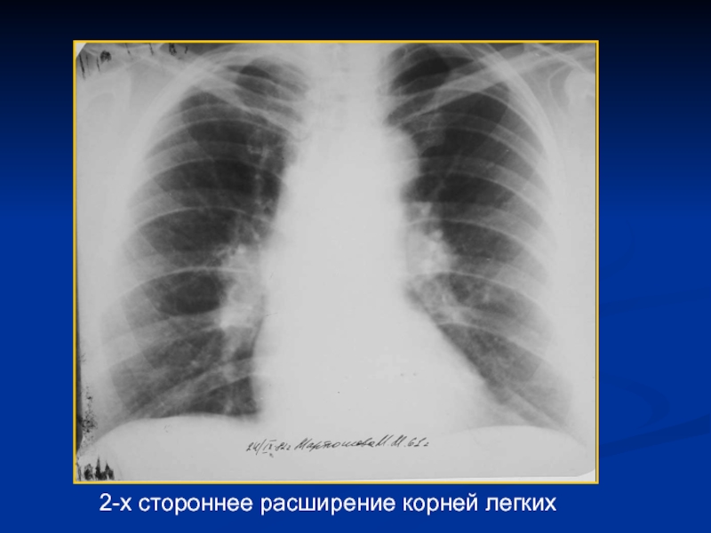 Ампутация корней легких при рентгенологической картине характерна для