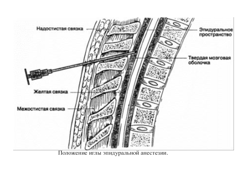 Схема эпидуральной анестезии
