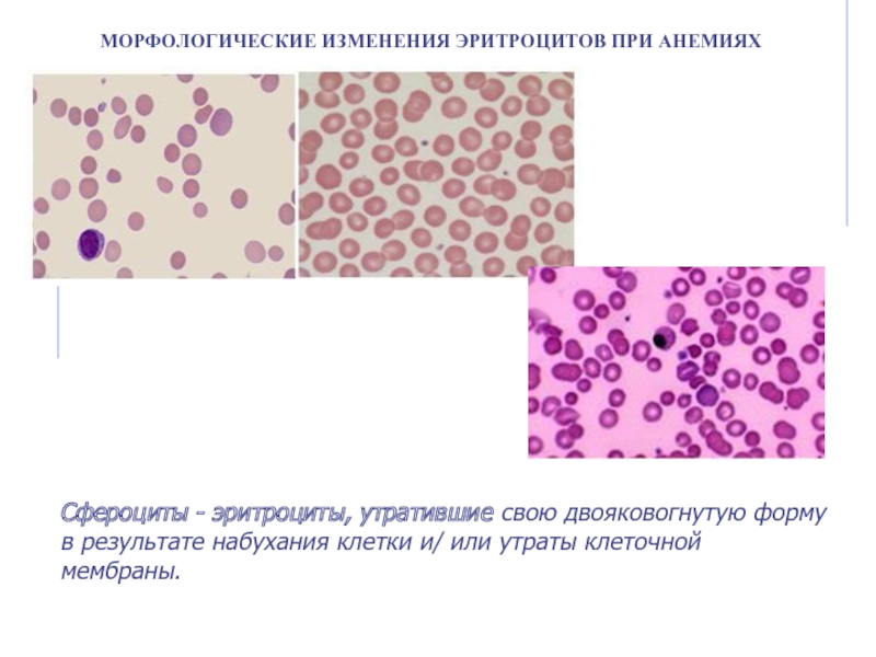 Морфологические изменения в эритроцитах рисунок