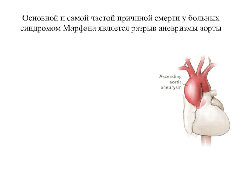 Аневризма сердца