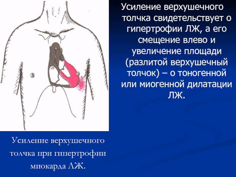 Сердечный толчок. Усиленный разлитой верхушечный толчок. Смещение верхушечного толчка. Усиление верхушечного толчка свидетельствует о. Смещение верхушечного толчка влево.