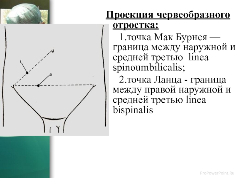 Маков точка. Точка Ланца и Мак Бурнея. Точка Мак Бурнея и Ланца при аппендиците. Точка Мак Бурнея и Ланца проекция. Проекция червеобразного отростка.