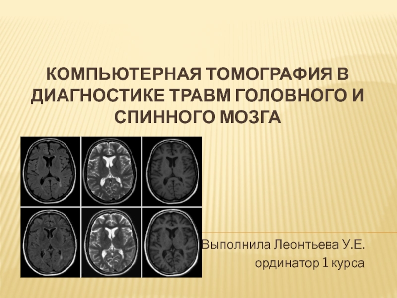 Презентация Компьютерная томография в диагностике травм головного и спинного мозга