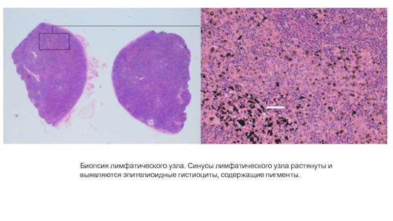 Биопсия лимфоузла. Гистиоциты гистология. Биопсия лимфатических узлов. Морфология неопухолевых лимфаденопатий. Гистиоциты морфология.