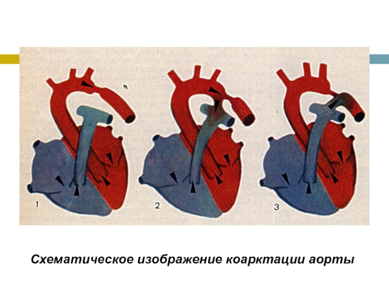 Как выглядит порок сердца на картинке