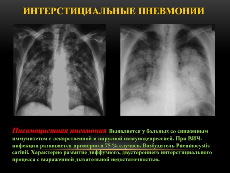 Ковид рентген картина