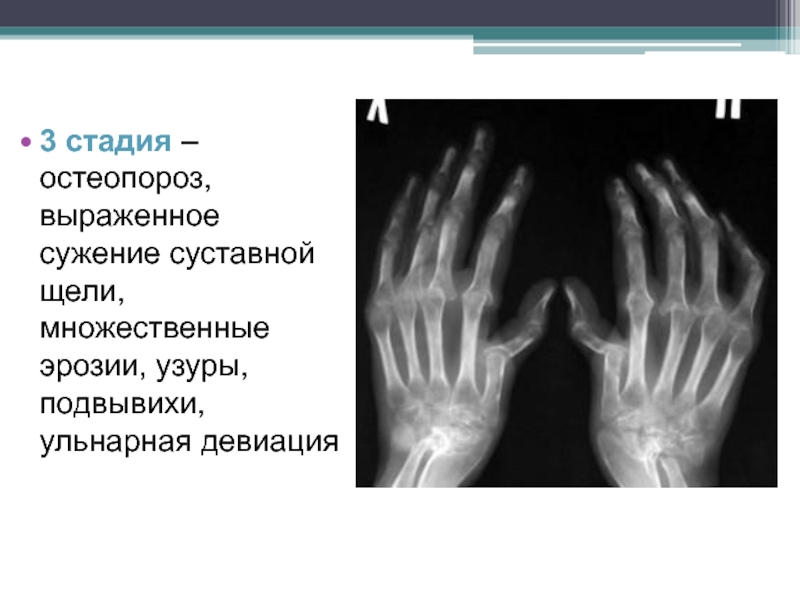 Ревматоидный артрит презентация