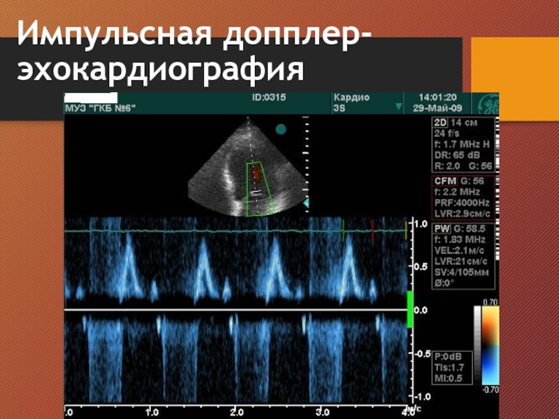 Эхокардиография заключение фото