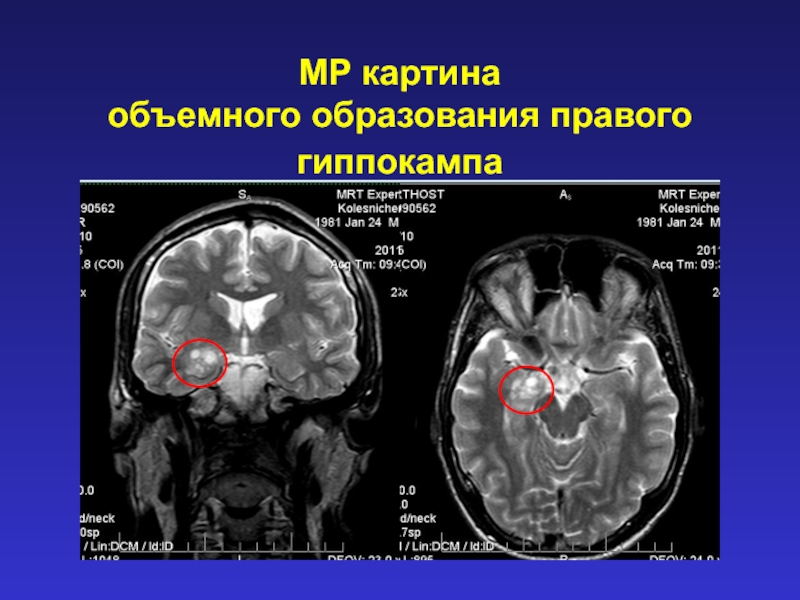 Образование правого. Гиппокамп анатомия мрт. Гиппокамп головного мозга на мрт. МР картина объемного образования. Анатомия гиппокампа на мрт.