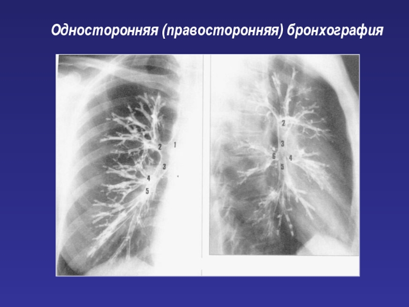 Бронхография. Рентгеновское исследование бронхов. Односторонняя (правосторонняя)бронхография. Контрастирование бронхиального дерева.