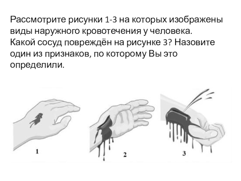 Рассмотрите рисунки 1 3 на которых изображены виды наружного кровотечения у человека