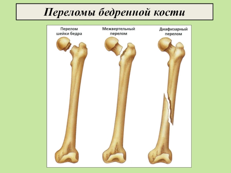 Бедренная кость фото. Анатомическая шейка бедренной кости. Перелом эпифиза бедренной кости. К большому вертелу (trochanter Major) бедренной кости прикрепляются. Анатомический перелом бедренноймкости.