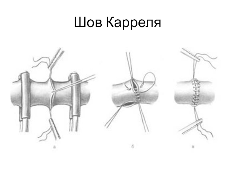 Сосудистый шов: как проходит наложение по Каррелю, виды