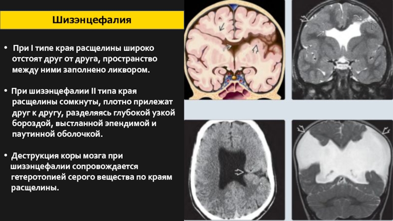 Шизэнцефалия мрт картинки