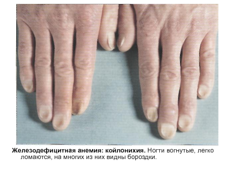 Железодефицитная анемия: койлонихия. Ногти вогнутые, легко ломаются, на многих из них видны бороздки.