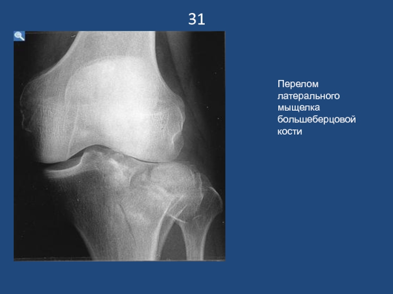 Наружный мыщелок большеберцовой кости фото