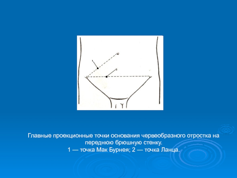 Точка основания. Точка Ланца и Мак Бурнея. Точка Ланца и Мак Бурнея топографическая анатомия. Точка Мак Бурнея и Ланца при аппендиците. Мак Бурнея точка пальпация.