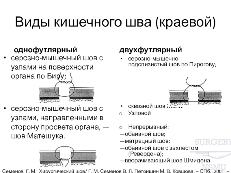 Кишечный шов. Классификация кишечных швов таблица. Кишечные швы топографическая анатомия. Кишечный шов серозно-серозные. Кишечный шов классификация серозно мышечный Узловой.