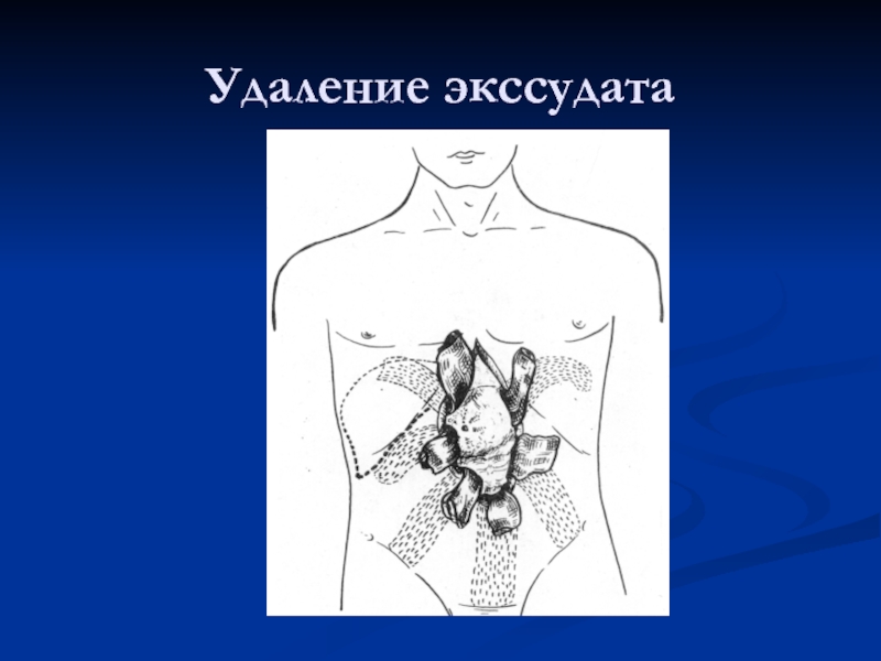 Удаление 20. Удаление Гнойного экссудата. Удаление Гнойного экссудата из раны.