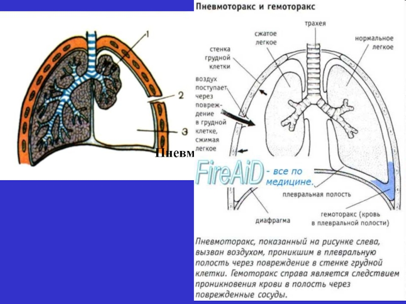 Презентация пневмоторакс и гемоторакс