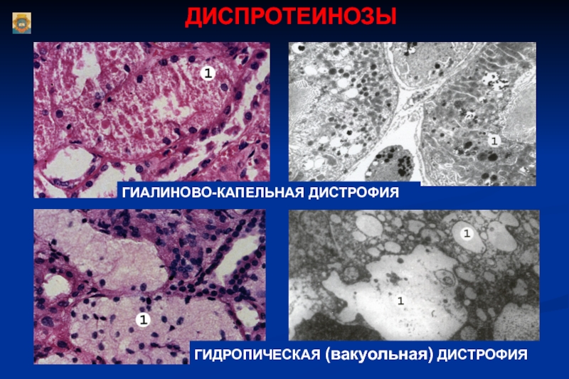 Схема паренхиматозные дистрофии морфологические проявления