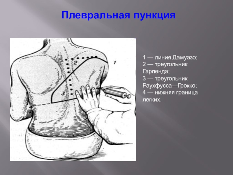 Плевральная пункция рисунок