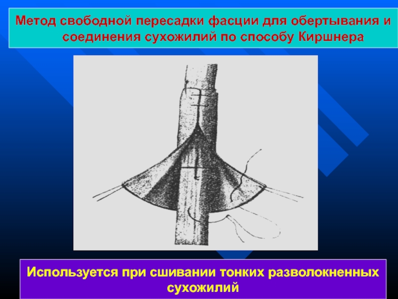 Презентация операции на сухожилиях