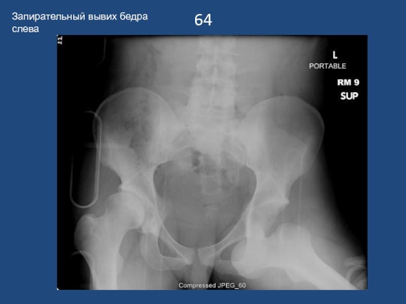Вывих бедра презентация