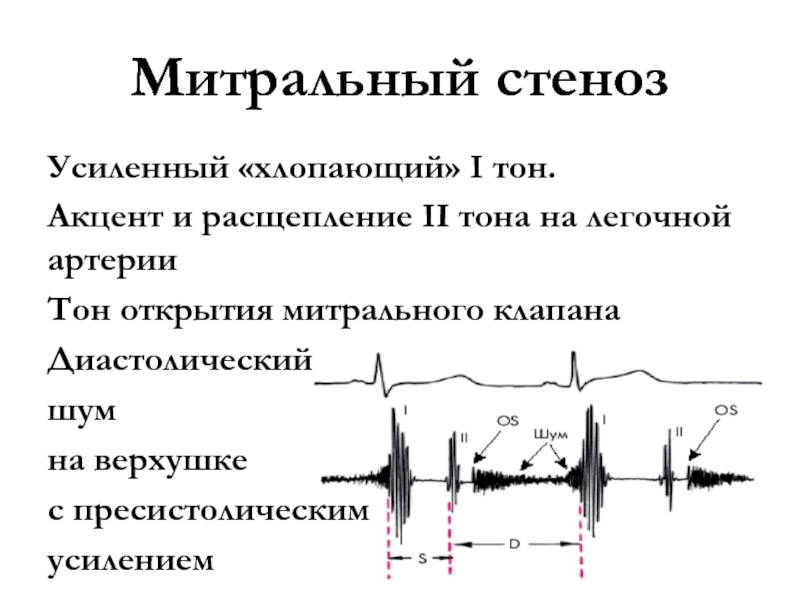 Аускультативная картина аортального стеноза