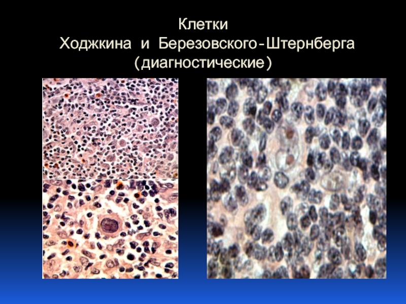 Клетки  Ходжкина и Березовского-Штернберга (диагностические)