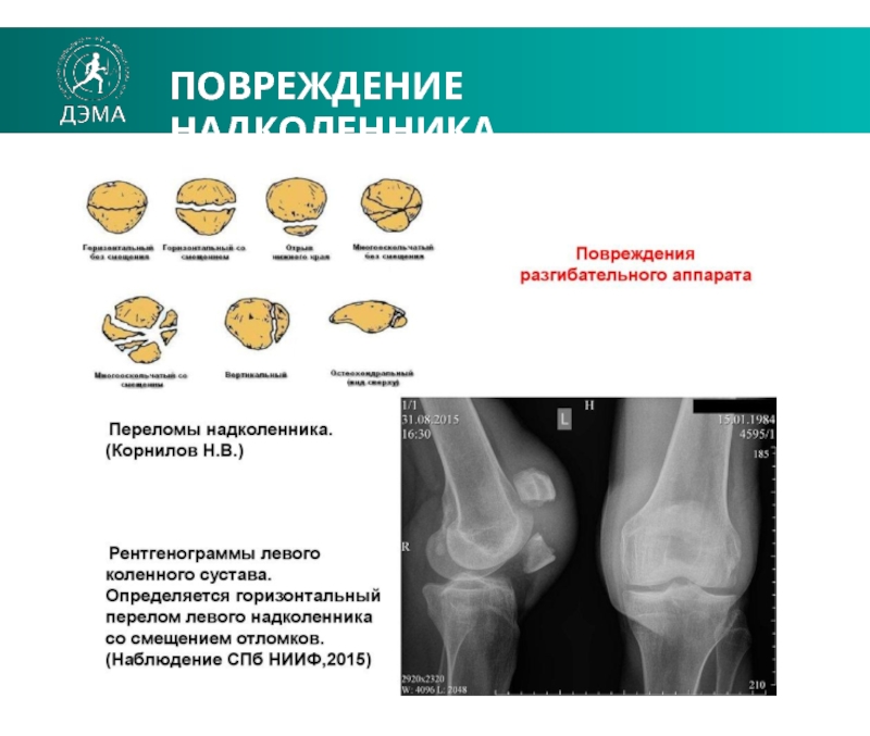 Перелом надколенника карта вызова