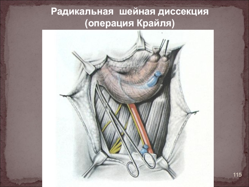 Операция Ванаха и Крайля. Радикальная шейная диссекция. Радикальная шейная лимфодиссекция. Операция Крайля ход операции.