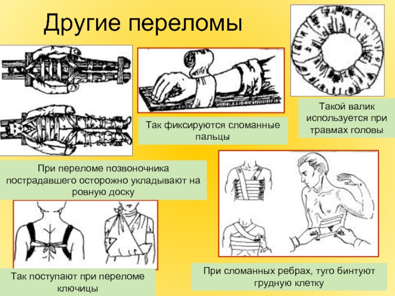 Первая помощь при ушибах переломах костей и вывихах суставов 8 класс презентация по биологии