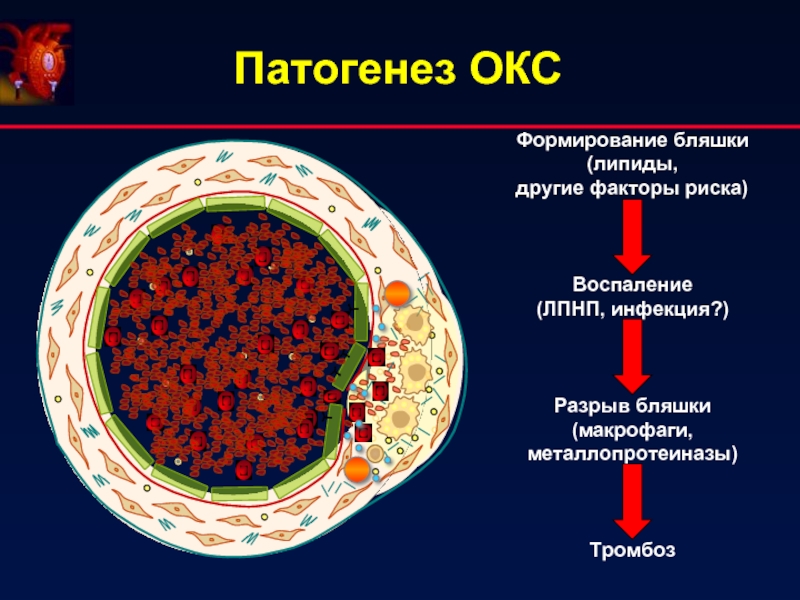 Патогенез ОКС Формирование бляшки(липиды, другие факторы риска)Воспаление(ЛПНП, инфекция?)Разрыв бляшки(макрофаги, металлопротеиназы)Тромбоз