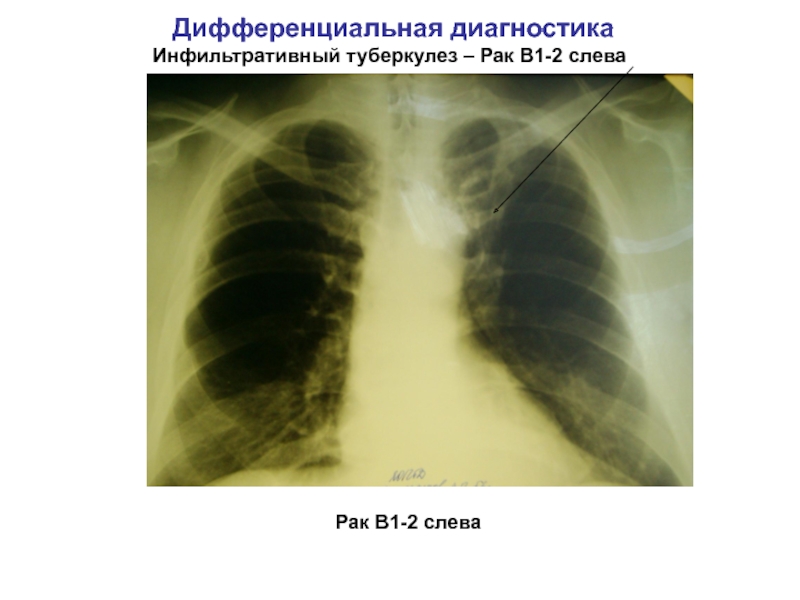 Очаговый и инфильтративный туберкулез презентация