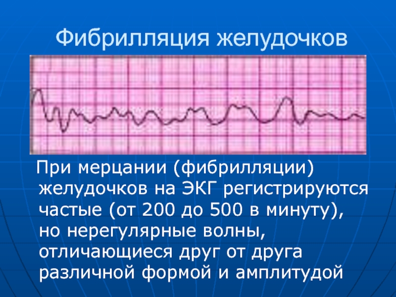 V2 на экг