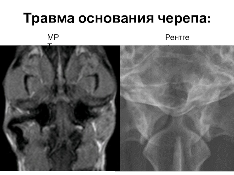 Травма основания черепа:РентгенМРТ