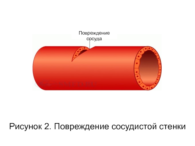 Рассмотрите рисунок с изображением повреждений кровеносных сосудов какой