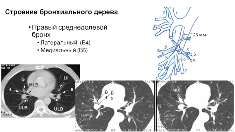 Бронхи на кт схема