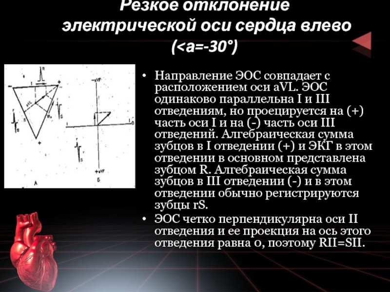 Отклонение эос влево. Резкое отклонение электрической оси сердца влево. Электрическая ось сердца резко отклонена влево. Отклонение отведения на ЭКГ вправо и влево. Электрическая ось сердца отведения.