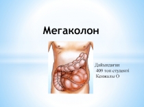 Мегаколон