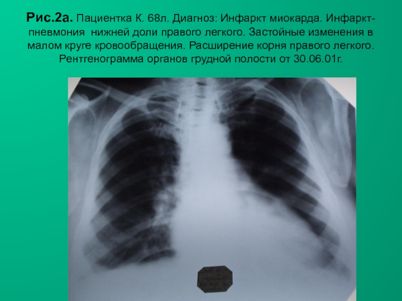 Н.С. Воротынцева, С.С. Гольев РентгенопульмонологияРис.2а. Пациентка К. 68л. Диагноз: Инфаркт миокарда. Инфаркт-пневмония нижней доли правого легкого. Застойные