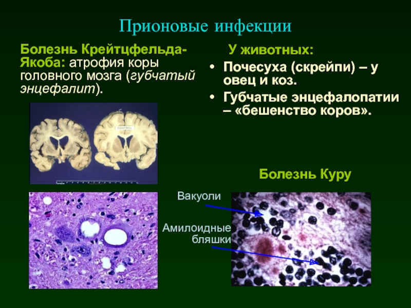 Болезнь куру. Болезнь Крейтцфельда-Якоба. Болезнь Крейтцфельдта-Якоба (БКЯ. Крейтцфельдта Якоба мозг гистология. Крайцфельда Якова гистология.