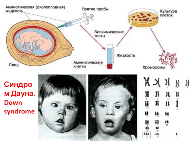 Генетика синдром дауна презентация