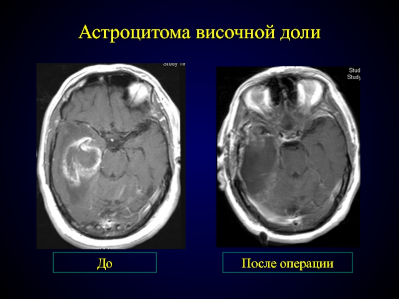 Астроцитома прогноз жизни после операции. Астроцитома головного. Астроцитома теменной доли. Объемные образования височной доли.