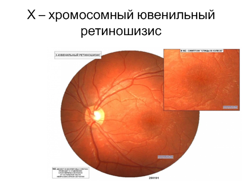 Х – хромосомный ювенильный ретиношизис