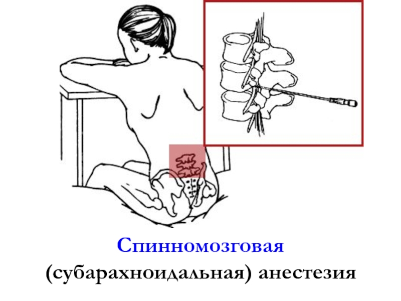 Спинномозговая анестезия. Спинномозговая (спинальная, субарахноидальная) анестезия техника. Спинальная анестезия положение иглы. Субарахноидальная анестезия. Положение больного при спинномозговой анестезии.