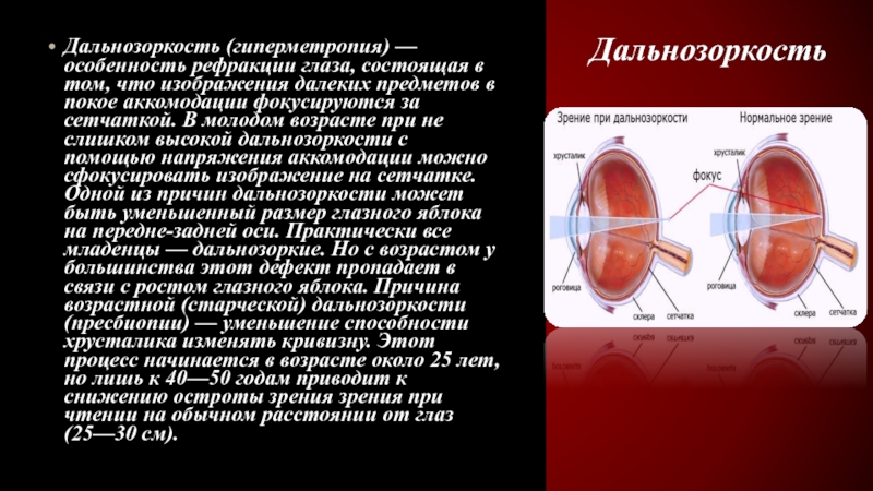 Гиперметропия глаза что это такое. Дальнозоркость хрусталик. Способность хрусталика изменять свою кривизну. Способность менять кривизну в хрусталике. При пресбиопии рефракция глаза.