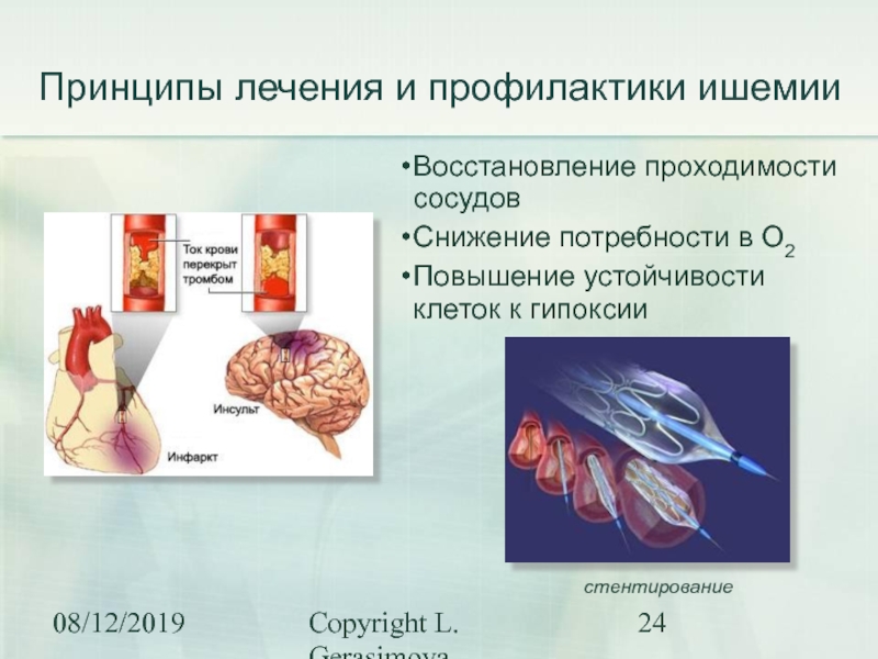 Гипоксия ишемия. Кто нибудь вылечил ишемию.