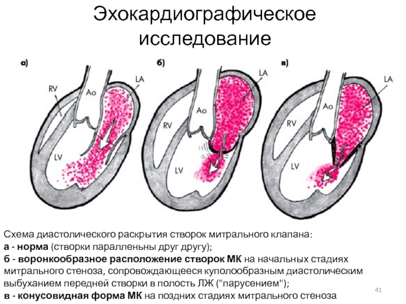 Митральный стеноз картинка